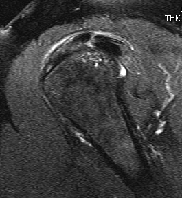 Shoulder MRI Calcific Tendonitis T2